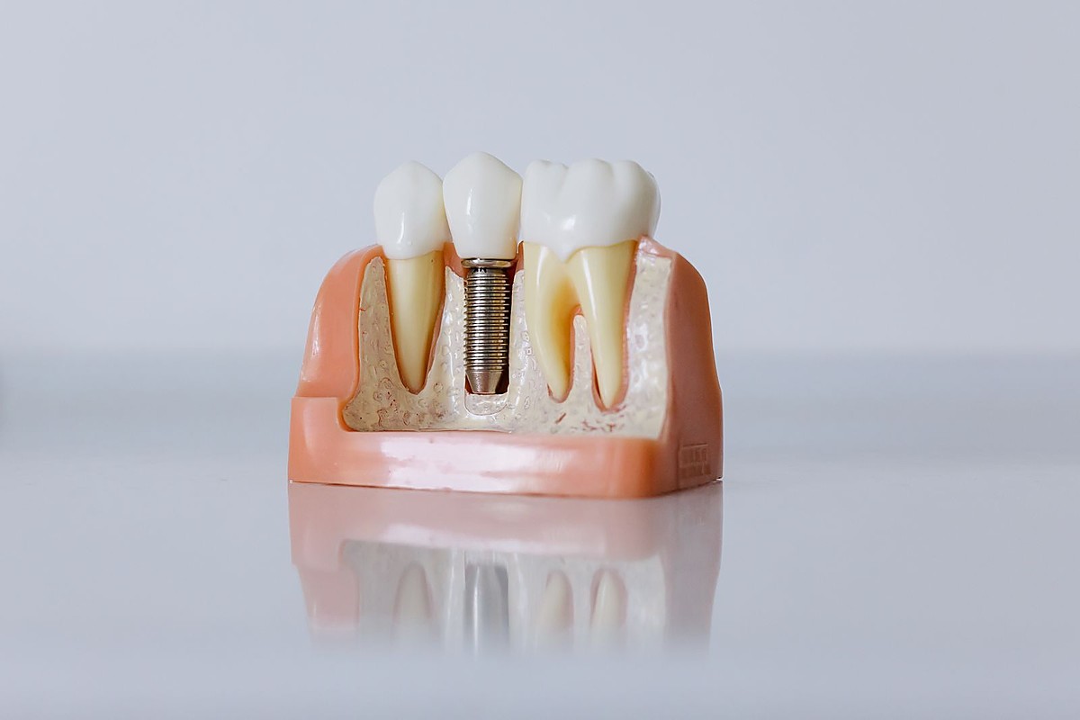 Dental implant treatment to replace missing teeth at Dental Dew Clinic Rohini