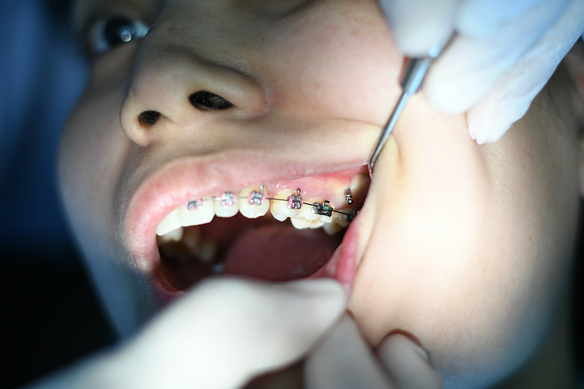 Orthodontic braces treatment for straighter teeth at Dental Dew Rohini