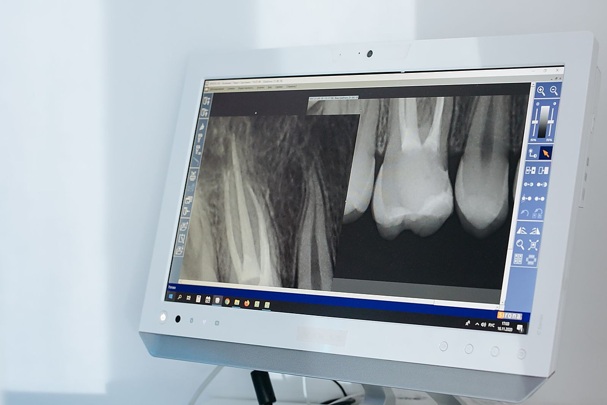 Root canal treatment to save an infected tooth at Dental Dew Rohini