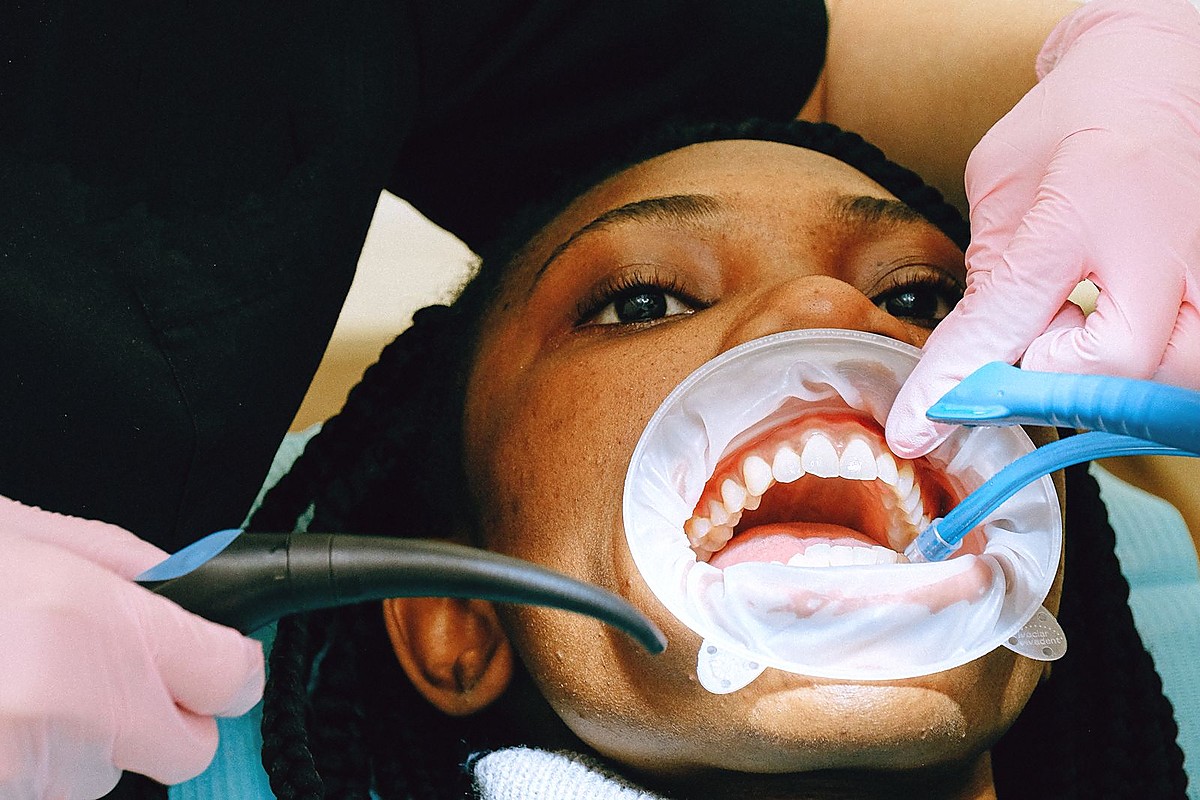 Professional teeth cleaning and scaling at Dental Dew Clinic Rohini