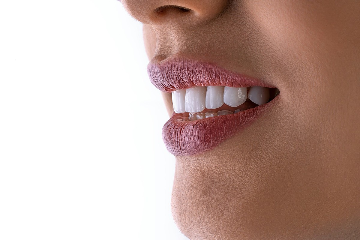 Professional teeth whitening for a brighter smile at Dental Dew Rohini