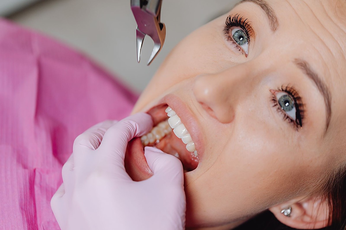 Safe tooth extraction procedure at Dental Dew Clinic in Rohini